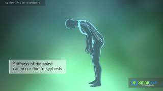 Kyphosis Symptoms [upl. by Evelinn]