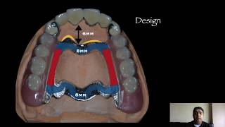 The Anteroposterior Palatal Strap major connector [upl. by Ylas]