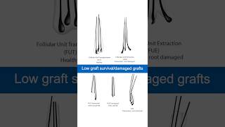 Potential Graft and Native Hair Loss in FUE Hair Transplants hairtransplant [upl. by Delmore656]