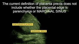 MARGINAL SINUS OF PLACENTA ABRUPTIO PLACENTA HEMORRHAGE PLACENTA PREVIA A2Z OF ULTRASOUND [upl. by Corkhill]