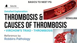 Thrombosis  Causes of Thrombosis  Thrombus  Thrombus vs Embolus  Hemostasis vs Thrombosis  KTC [upl. by Nonarb]