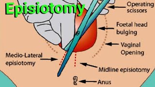 Episiotomy  indication  complications types  median vs medio lateral episiotomy [upl. by Tamiko283]