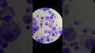 Mesothelial Cells in Pleural Fluid  Body Fluid  Fluids Giemsa Stain [upl. by Adnoral]