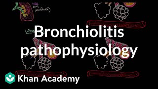 Bronchiolitis pathophysiology  Respiratory system diseases  NCLEXRN  Khan Academy [upl. by Katsuyama]