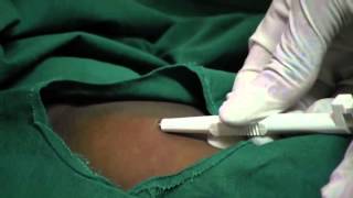 Contraceptive Implants  11  Procedure Insert implant [upl. by Betsy657]