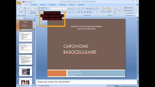 carcinome basocellulaire [upl. by Divad]