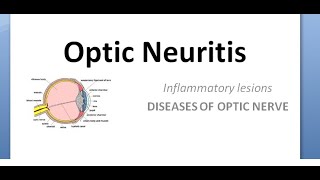 Ophthalmology Optic neuritis Papillitis NeuroRetinitis RetroBulbar phosphenes uhthoff pulfrich [upl. by Drofdarb]