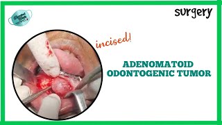 ENUCLEATION OF ADENOMATOID ODONTOGENIC TUMOR  REAL TIME SURGERY [upl. by Donoho]