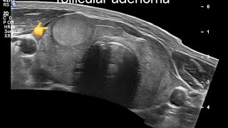 Understanding Thyroid follicular Adenomas Ultrasound and Doppler Insights for Accurate Diagnosis [upl. by Alurta]