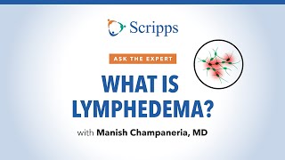 What Is Lymphedema and How Is It Treated  Ask The Expert [upl. by Etiam]