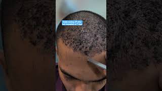 How scabs come off after hair transplant Is it safe to wash hair transplant at 7 days [upl. by Sanjiv]