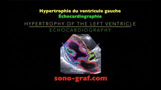 Échocardiographie  Hypertrophie du ventricule gauche [upl. by Aerda]