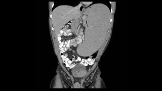 Hepatomegaly amp splenomegaly Hepatosplenomegaly by profMarwa AlEmam [upl. by Aneala42]