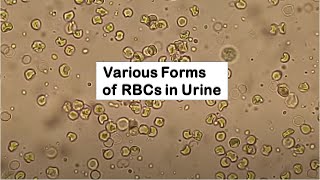 Various Forms of RBCs in Urine Microscopy I hematuria [upl. by Sidky]