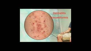 🍁 Dermatitis Herpetiformis 🍁 [upl. by Sarson]