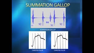 gallop rhythm [upl. by Einafpets]