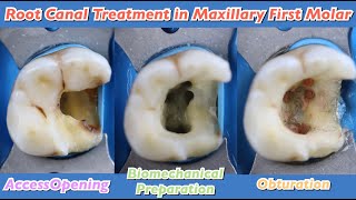 root canal treatment in maxillary first molar 🟢 endostar e3 azure 🟡mesiobuccal canalsmb1 and mb2 [upl. by Anehc]