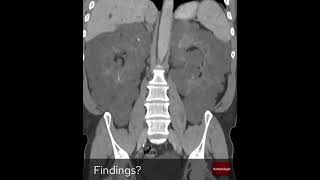 Coronal slices of an abdominal CT From The Radiologist [upl. by Rudyard]