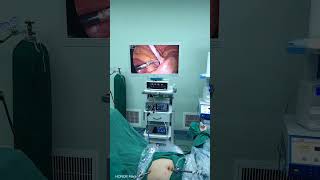 Laparoscopic appendectomy [upl. by Illac922]