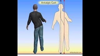 Antalgic Gait  Definition causes characteristics Disease association Diagnosis Treatment [upl. by Rhea316]