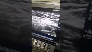 US guided genitofemoral nerve block [upl. by Haimirej965]