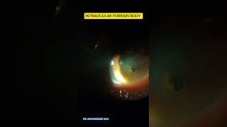 INTRAOCULAR FOREIGN BODY eyes OCULAR TRAUMA [upl. by Hicks]