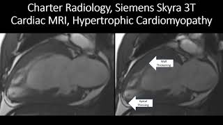 MRI Cardiac Morphology Hypertrophic Cardiomyopathy [upl. by Ellinger]