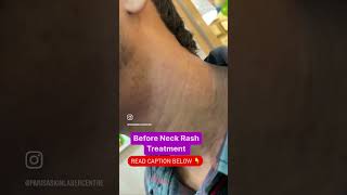 Neck rash Atopic Dermatitis  Childhood Eczema drashimagoel dermatologistinchandigarh shorts [upl. by Iruam]