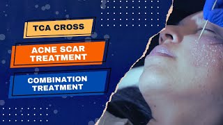 TCA Cross  Acne Scar Treatment  Jason Emer MD  Combination Treatment [upl. by Asille657]