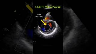 Cleft Mitral Valve echocardiography heart [upl. by Doug]