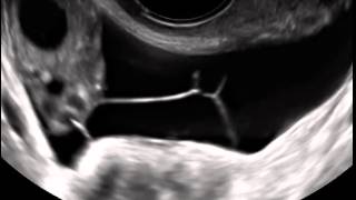 Ultrasound in Obstetrics amp Gynecology A Practical Approach  Clip 124 [upl. by Nickles]