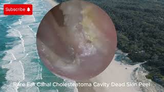 Rare Ear Canal Cholesteatoma Cavity Dead Skin Peel  EAR CLEANING [upl. by Allemrac]