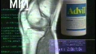 Advil Advanced medicine for pain commercial 1997 [upl. by Corenda]