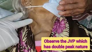 Raised JVP with Hepatojugular Reflux [upl. by Trinity]