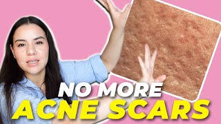 How To TREAT amp PREVENT Acne Scars  Accutane Series EP8 [upl. by Eylk]