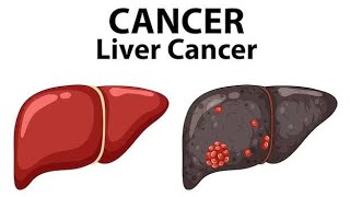 LIVER CANCER BSC NURSINGdailypost [upl. by Arrec811]