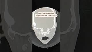 Cholesteatoma with Mastoiditis CT Temporal Bones [upl. by Ameen]