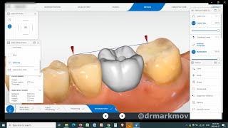 Cerec Primescan Measure Tool for Designing [upl. by Vanderhoek]