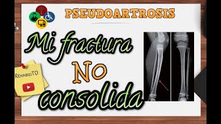 Fractura que no consolida  Pseudoartrosis [upl. by Draneb]