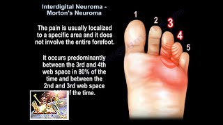 Interdigital Neuroma Mortons Neuroma  Everything You Need To Know  Dr Nabil Ebraheim [upl. by Kreit565]