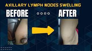 Case of Axillary lymph nodes swelling [upl. by Lauretta]