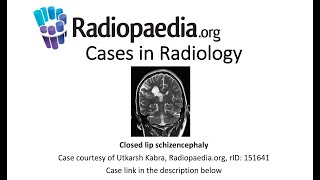 Closed lip schizencephaly Radiopaediaorg Cases in Radiology [upl. by Goulet]