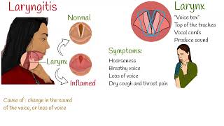 Laryngitis  Symptoms causes and treatment [upl. by Batholomew544]