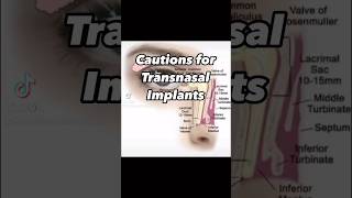 Cautions for Transnasal Implants [upl. by Clarice]