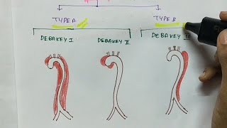 Aneurysms and Aortic dissection  Pathology  Handwritten notes [upl. by Ylelhsa]