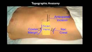 Ultrasound Guided Transversus Abdominis Plane Block [upl. by Yerga589]