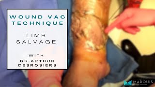 Correct wound VAC technique DrArthurMiami  negative Pressure wound therapy  limb salvage [upl. by Eralc157]