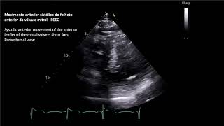 MIOCARDIOPATIA HIPERTROFICA OBSTRUTIVA  OBSTRUCTIVE HYPERTROPHIC MYOCARDIOPATHY [upl. by Hamburger]