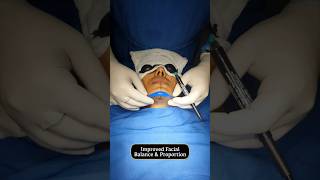 Chin Implant Transformation  Sarayu Clinics beauty [upl. by Druce453]