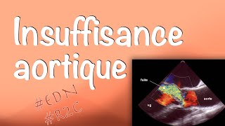 Insuffisance aortique  Valvulopathies cardiaques item 233 des EDN [upl. by Imaon]